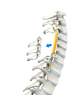 Cervical laminectomy