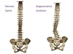 Degenerative Scoliosis