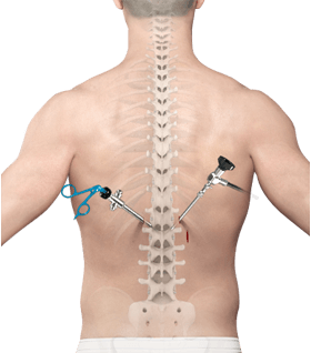 Minimally Invasive Lumbar Fusion